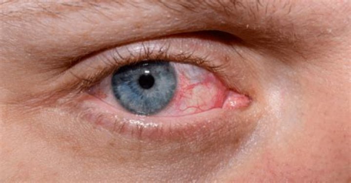 Can Sjogren’s go into remission?