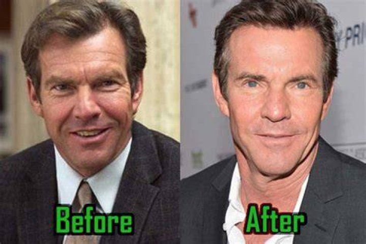 Dennis Quaid plastic surgery