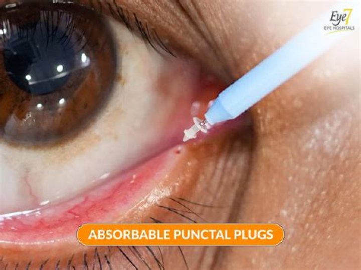 Does insurance cover punctal plugs?