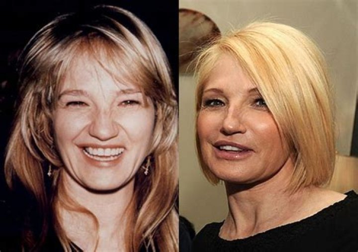 Ellen Barkin Plastic Surgery Nose Job