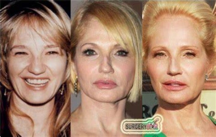 Ellen Barkin Plastic Surgery Update