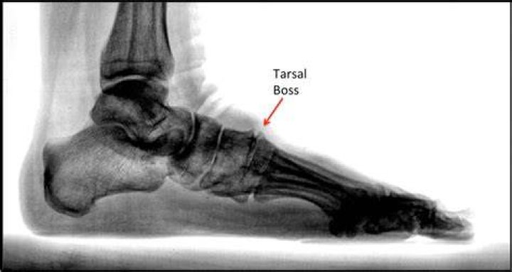 What causes a tarsal boss?