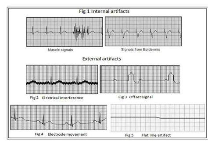 What does artifact mean on ECG?