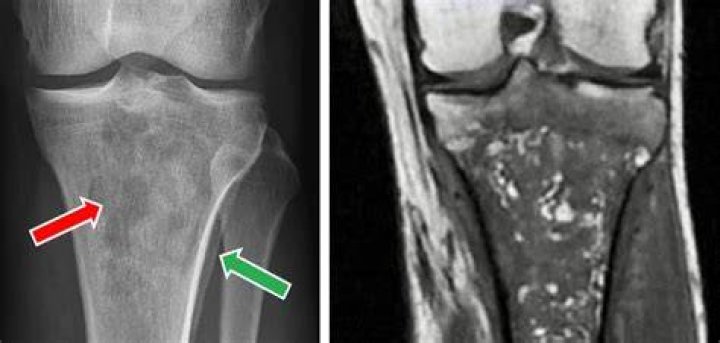 What does osteomyelitis look like on xray?