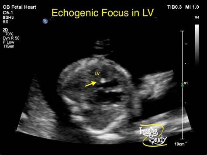 What is echogenic focus in left ventricle?