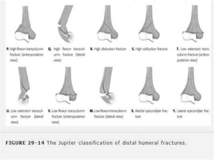 What is Hume fracture?