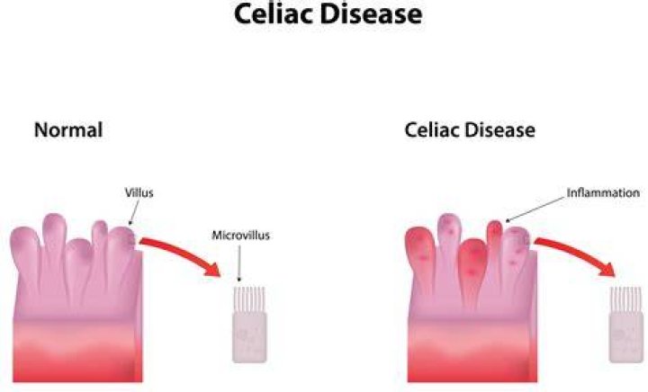 Why does celiac disease cause Steatorrhea?